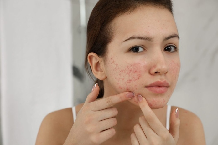 Why Do Pimples Leave Dark Spots