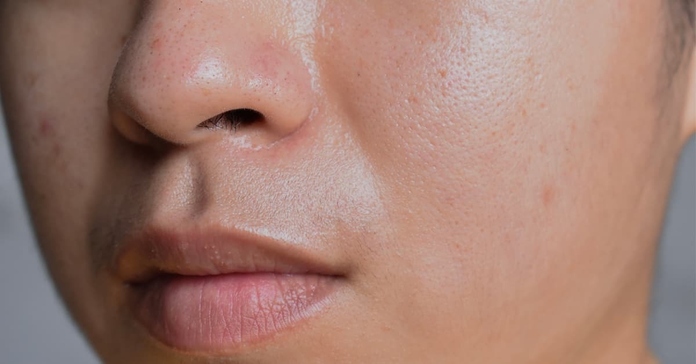 What Causes Oily Skin